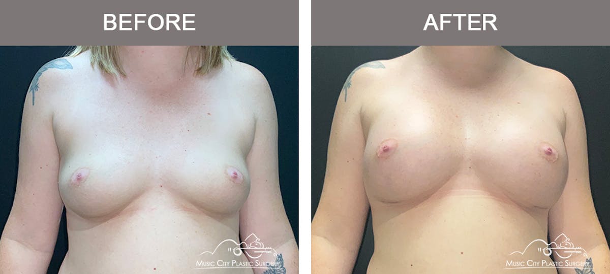 Breast Augmentation Before & After Gallery - Patient 119619 - Image 1