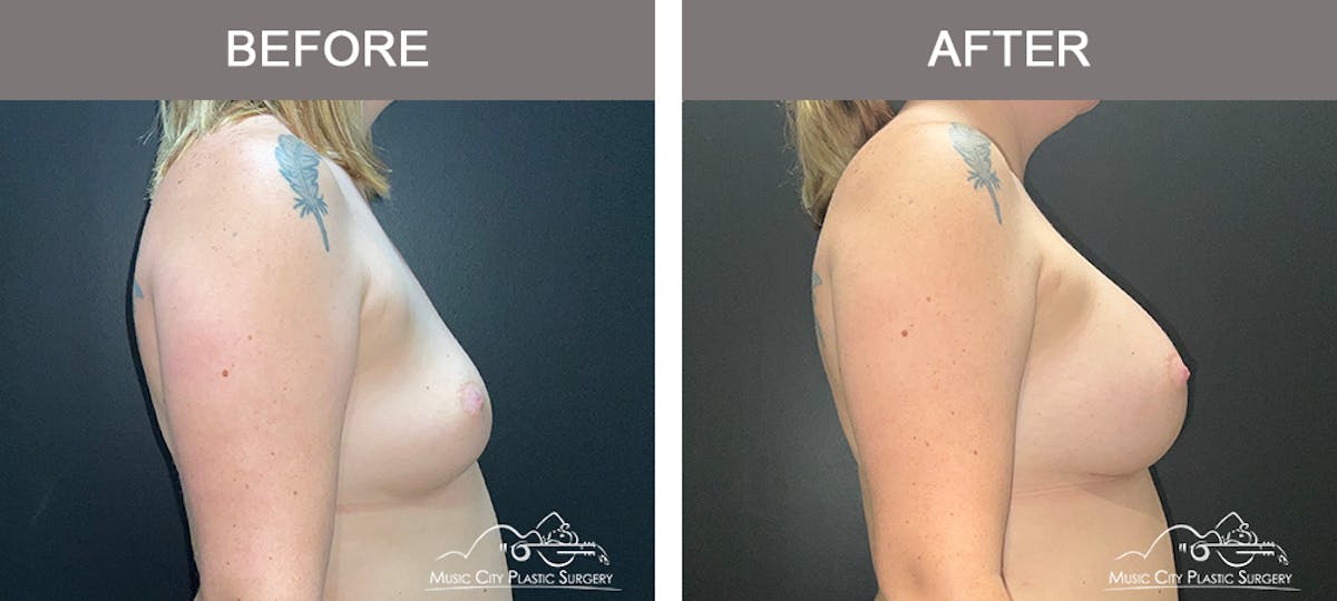Breast Augmentation Before & After Gallery - Patient 119619 - Image 3