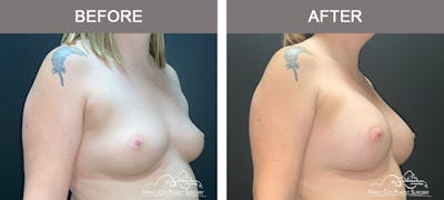 Breast Augmentation Before & After Gallery - Patient 119619 - Image 2