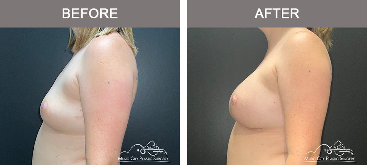 Breast Augmentation Before & After Gallery - Patient 119619 - Image 5