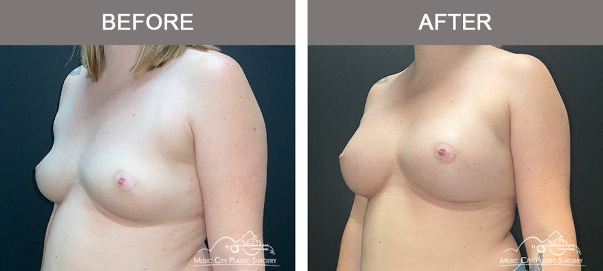 Breast Augmentation Before & After Gallery - Patient 119619 - Image 4