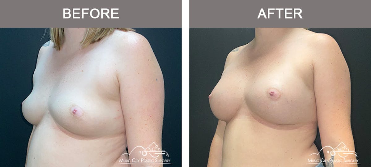 Breast Augmentation Before & After Gallery - Patient 119619 - Image 4