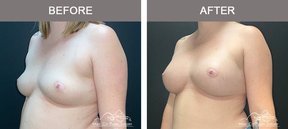 Breast Augmentation Before & After Gallery - Patient 119619 - Image 4