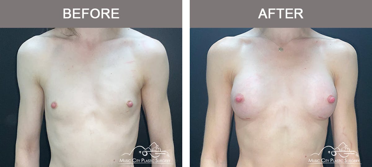 Breast Augmentation Before & After Gallery - Patient 266519 - Image 1