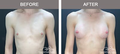 Breast Augmentation Before & After Gallery - Patient 266519 - Image 1