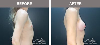 Breast Augmentation Before & After Gallery - Patient 266519 - Image 3