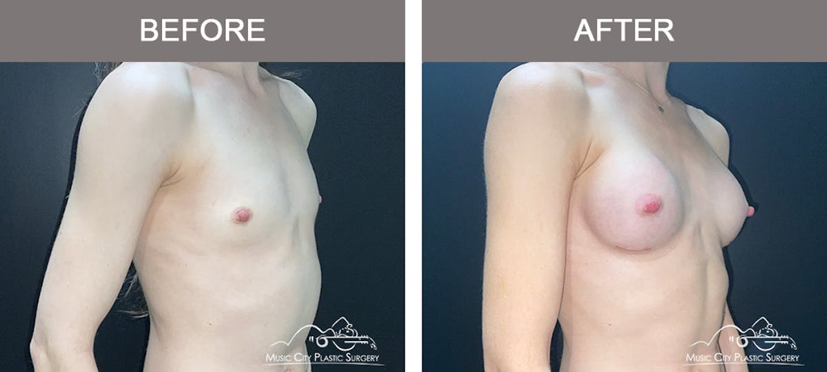 Breast Augmentation Before & After Gallery - Patient 266519 - Image 2