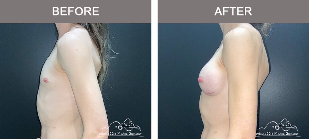 Breast Augmentation Before & After Gallery - Patient 266519 - Image 4