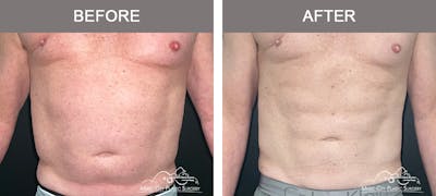 Male Liposuction Before & After Gallery - Patient 343996 - Image 1