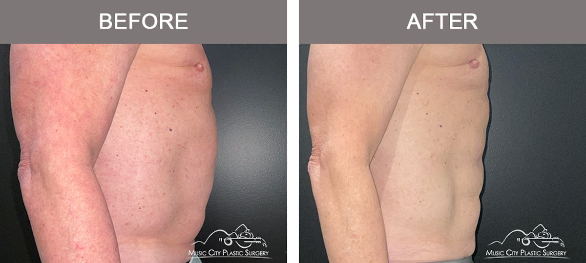 Male Liposuction Before & After Gallery - Patient 343996 - Image 3
