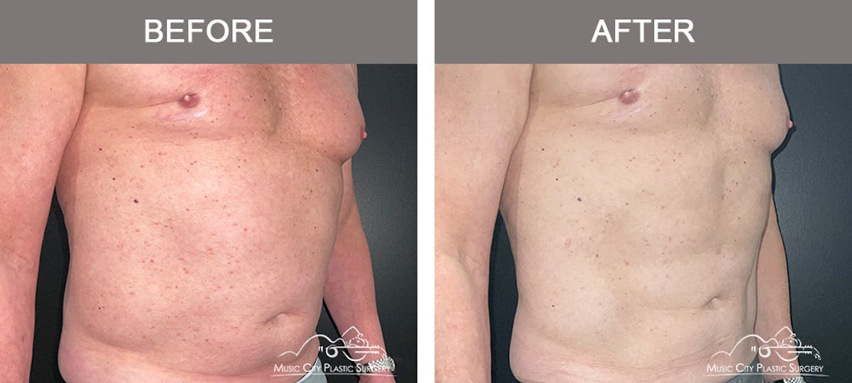 Male Liposuction Before & After Gallery - Patient 343996 - Image 2