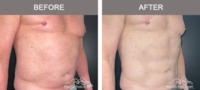 Male Liposuction Before & After Gallery - Patient 343996 - Image 2