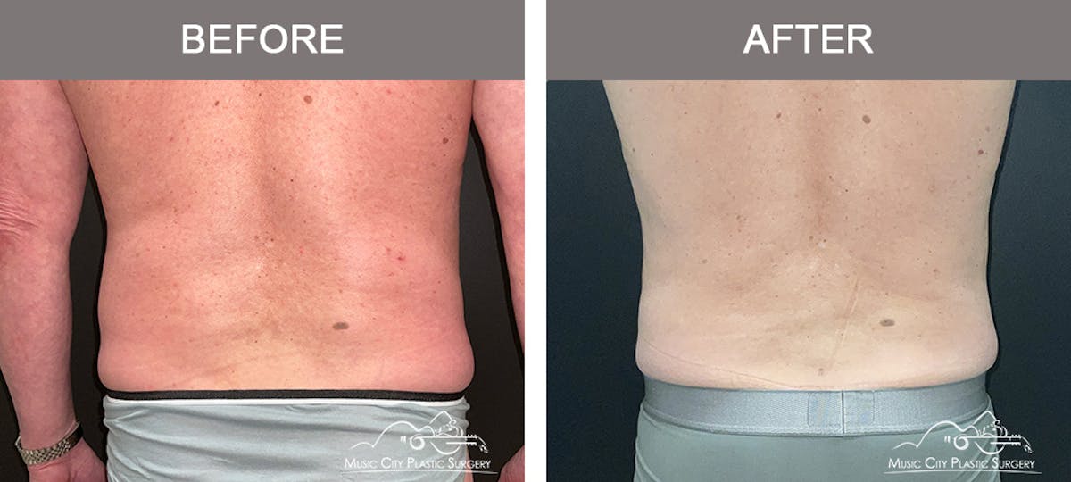 Male Liposuction Before & After Gallery - Patient 343996 - Image 6