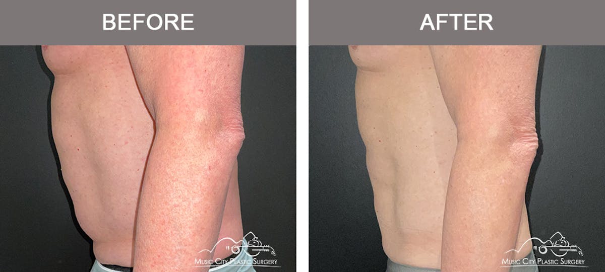 Male Liposuction Before & After Gallery - Patient 343996 - Image 5
