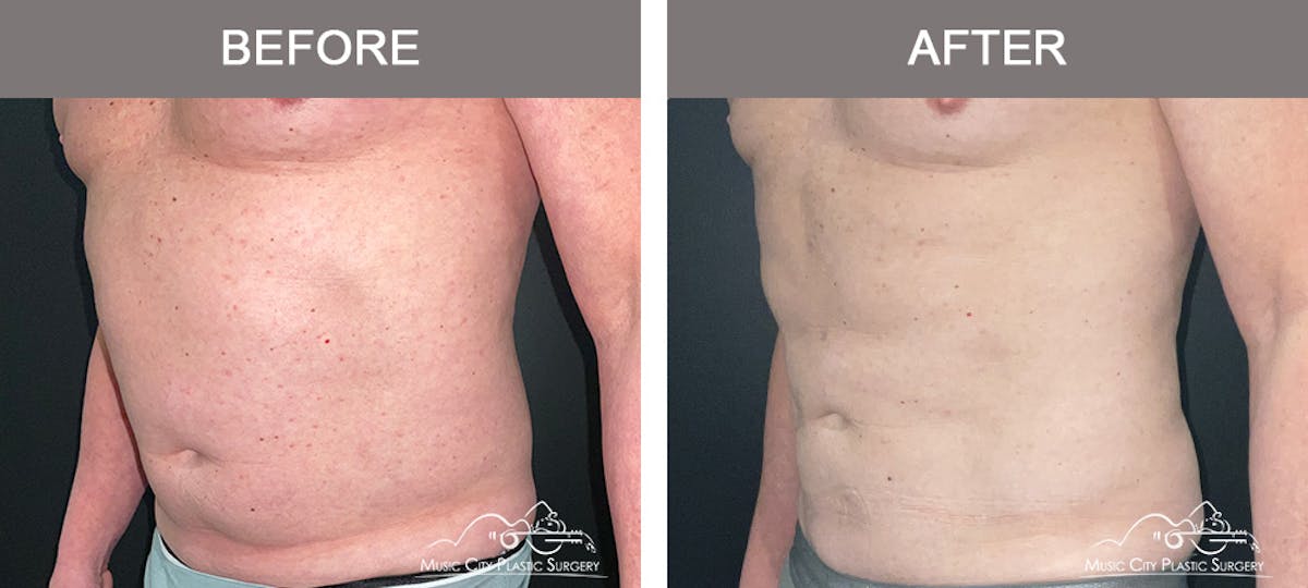 Male Liposuction Before & After Gallery - Patient 343996 - Image 4
