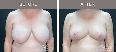 Breast Lift Before & After Gallery - Patient 311139 - Image 1