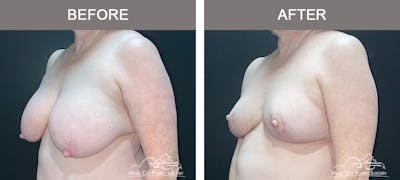Breast Lift Before & After Gallery - Patient 311139 - Image 2