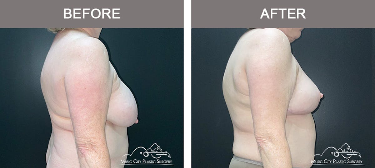 Breast Lift Before & After Gallery - Patient 311139 - Image 4