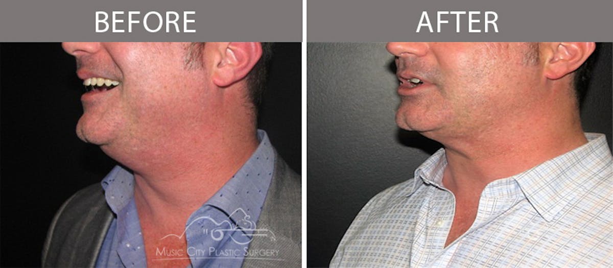 Dermal Fillers Before & After Gallery - Patient 351740 - Image 3