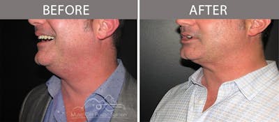 Dermal Fillers Before & After Gallery - Patient 351740 - Image 3
