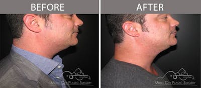 Dermal Fillers Before & After Gallery - Patient 351740 - Image 2