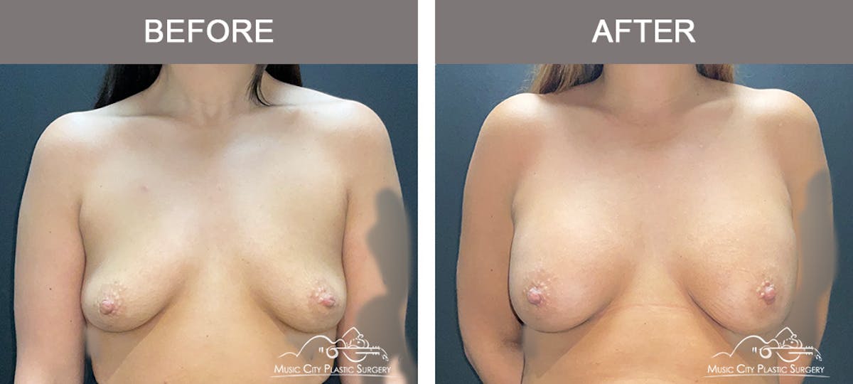 Breast Augmentation Before & After Gallery - Patient 421324 - Image 1