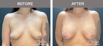 Breast Augmentation Before & After Gallery - Patient 421324 - Image 1