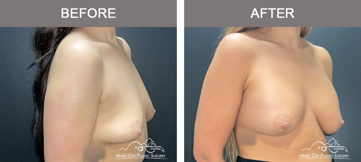 Breast Augmentation Before & After Gallery - Patient 421324 - Image 3