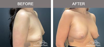 Breast Augmentation Before & After Gallery - Patient 421324 - Image 3