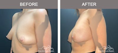 Breast Augmentation Before & After Gallery - Patient 421324 - Image 2