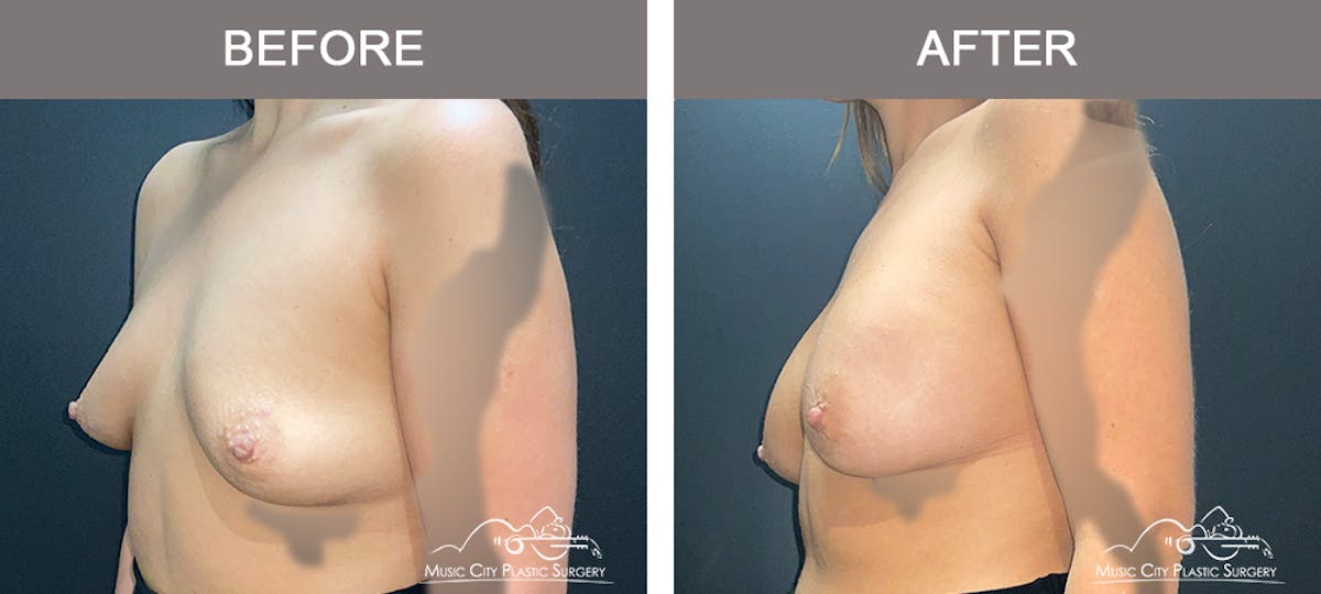 Breast Augmentation Before & After Gallery - Patient 421324 - Image 2