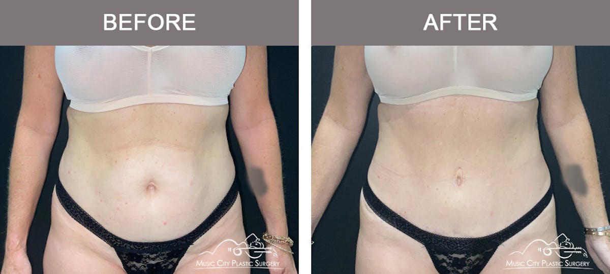 Liposuction Before & After Gallery - Patient 172585 - Image 1