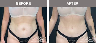 Liposuction Before & After Gallery - Patient 172585 - Image 1