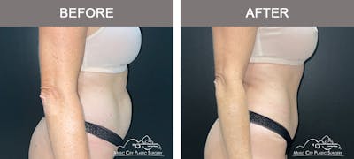 Liposuction Before & After Gallery - Patient 172585 - Image 3