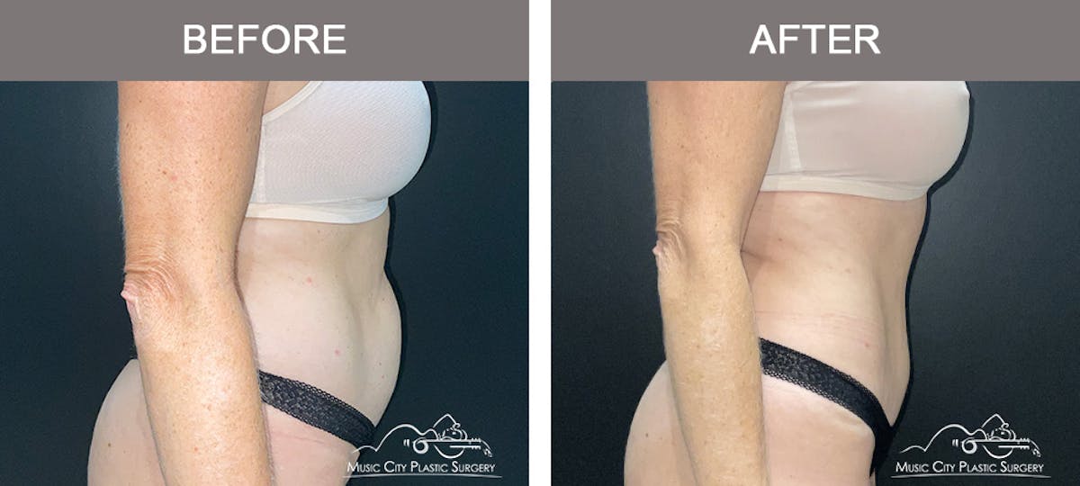 Liposuction Before & After Gallery - Patient 172585 - Image 3
