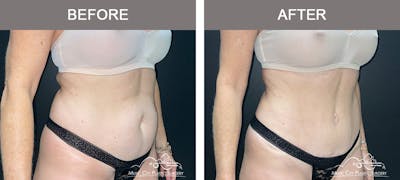 Liposuction Before & After Gallery - Patient 172585 - Image 2