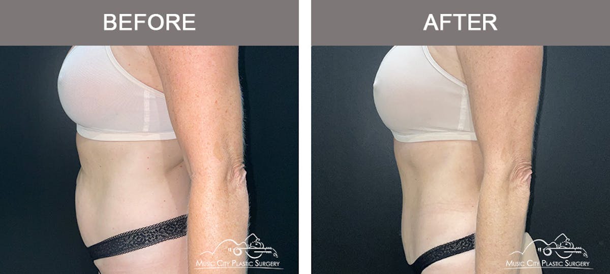 Liposuction Before & After Gallery - Patient 172585 - Image 5