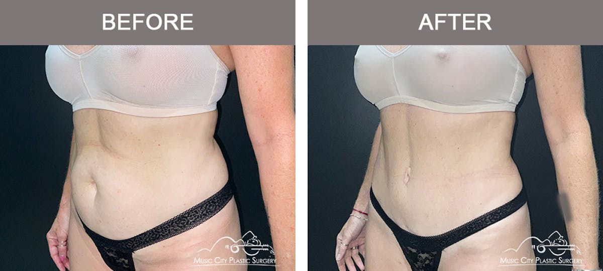 Liposuction Before & After Gallery - Patient 172585 - Image 4