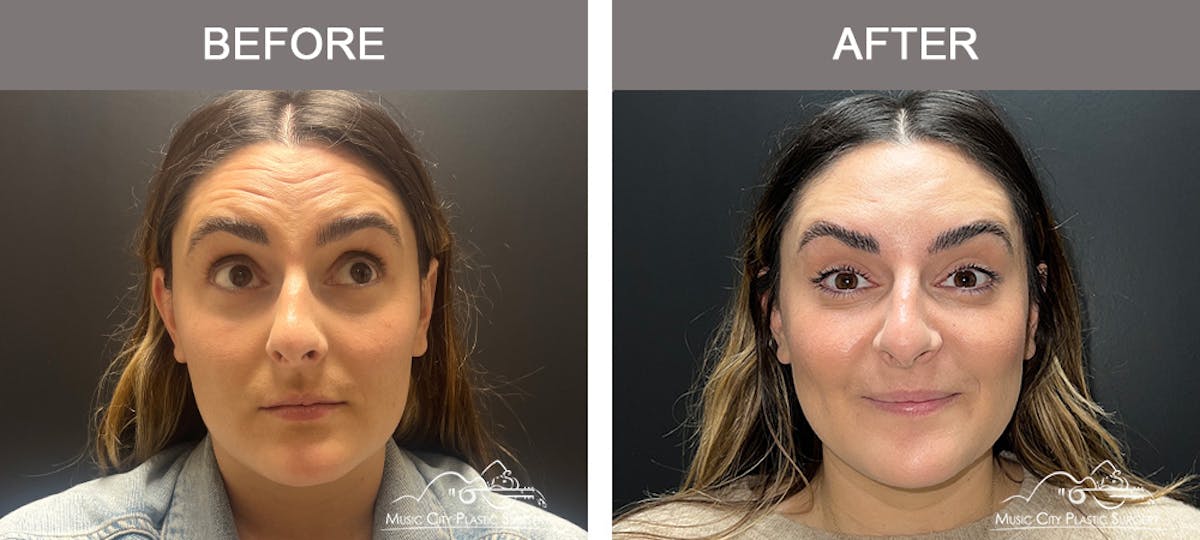 Dysport or Botox Before & After Gallery - Patient 431059 - Image 1