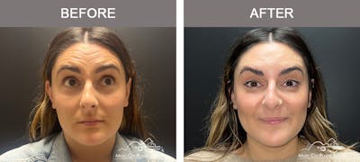 Dysport or Botox Before & After Gallery - Patient 431059 - Image 1