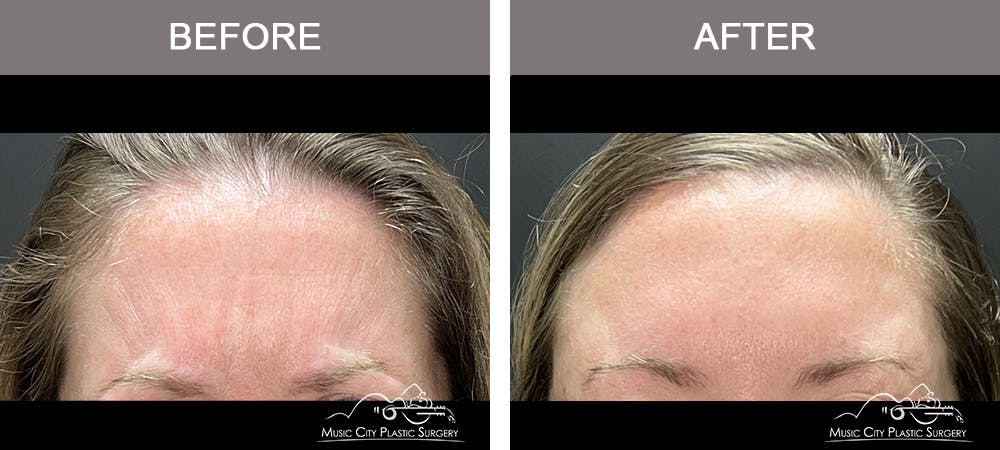 Dysport or Botox Before & After Gallery - Patient 418869 - Image 1