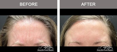 Dysport or Botox Before & After Gallery - Patient 418869 - Image 1