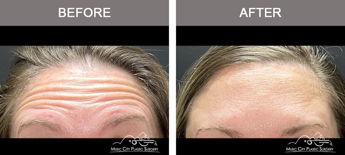 Dysport or Botox Before & After Gallery - Patient 418869 - Image 2