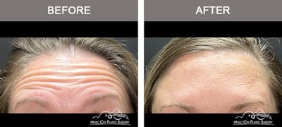 Dysport or Botox Before & After Gallery - Patient 418869 - Image 2