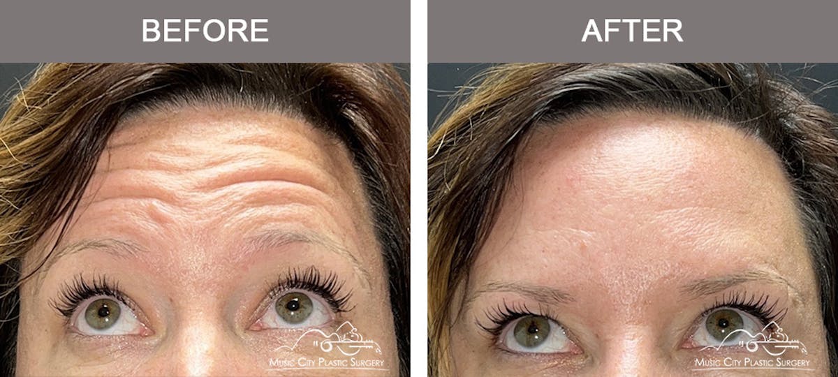 Dysport or Botox Before & After Gallery - Patient 295546 - Image 1