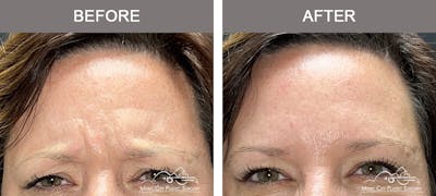 Dysport or Botox Before & After Gallery - Patient 295546 - Image 2