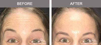 Dysport or Botox Before & After Gallery - Patient 208828 - Image 1