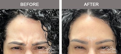Dysport or Botox Before & After Gallery - Patient 214806 - Image 1