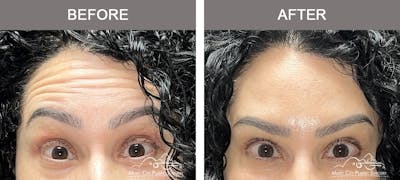 Dysport or Botox Before & After Gallery - Patient 214806 - Image 2