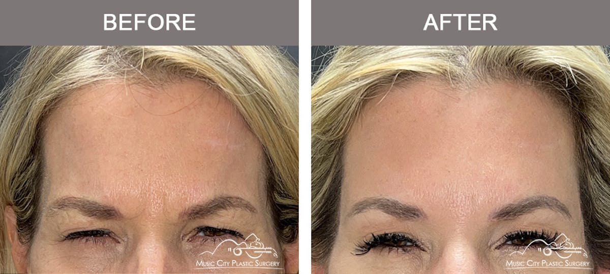 Dysport or Botox Before & After Gallery - Patient 400159 - Image 1